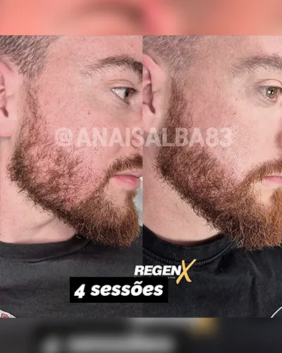 Anais-Alba-@anaisalba83-cabelo-a2-4-sessoes.webp