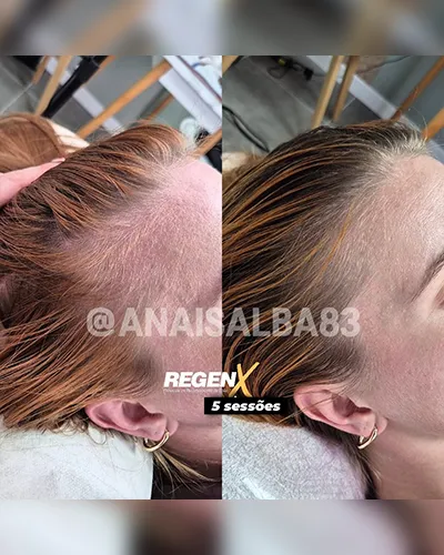 Anais-Alba-@anaisalba83-cabelo-a2-5-sessoes.webp